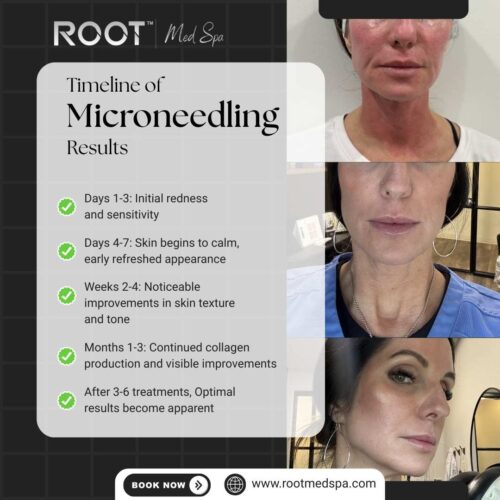 Timeline of Microneedling Benefits