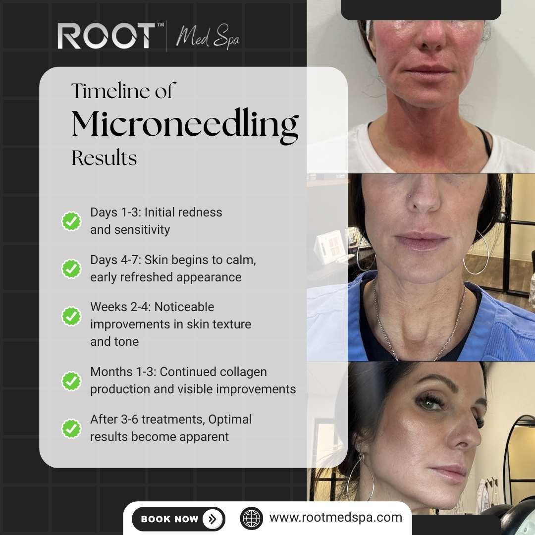 Timeline of Microneedling Benefits