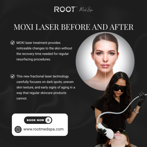 MOXI Laser Before and After in Flower Mound/Coppell, TX