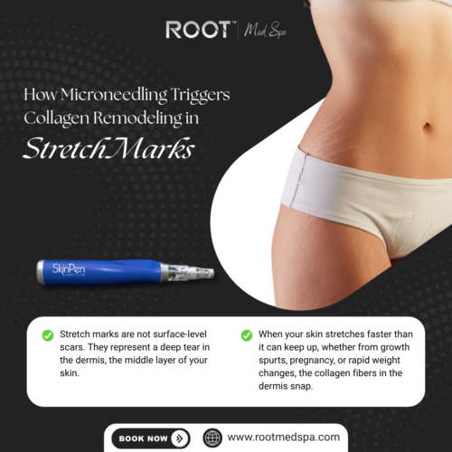 How Microneedling Triggers Collagen Remodeling in Stretch Marks
