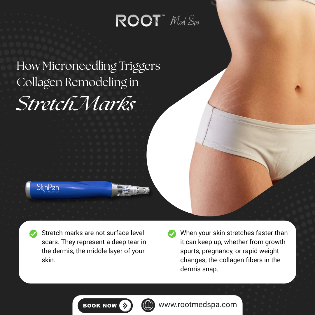 How Microneedling Triggers Collagen Remodeling in Stretch Marks