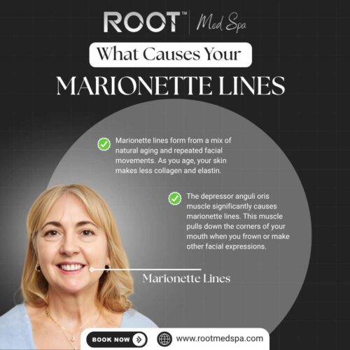 What Causes Your Marionette Lines