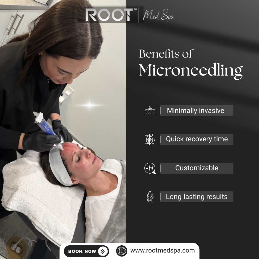 Benefits of Microneedling 