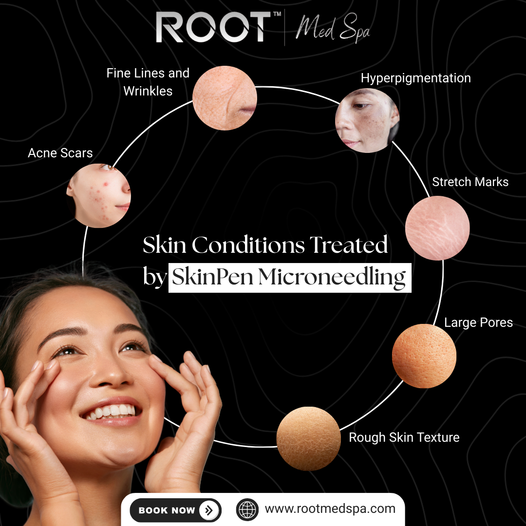 Skin Conditions Treated by SkinPen Microneedling in Flower Mound/Dallas, TX