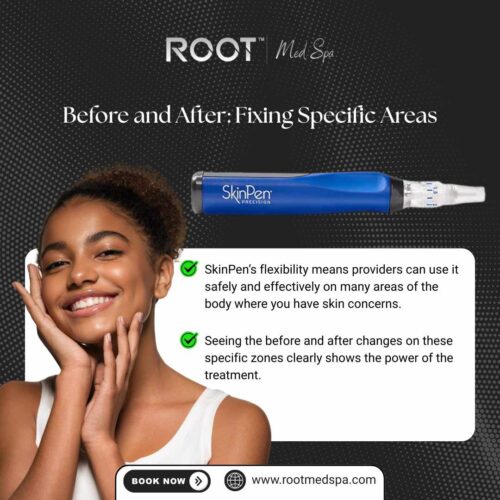Microneedling Before and After in Flower Mound/Dallas, TX: Fixing Specific Areas
