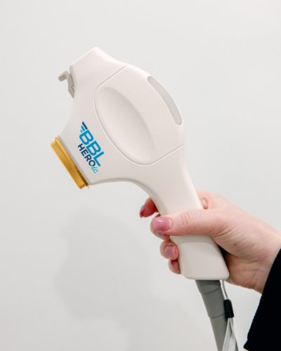 2 BBL Laser Treatments