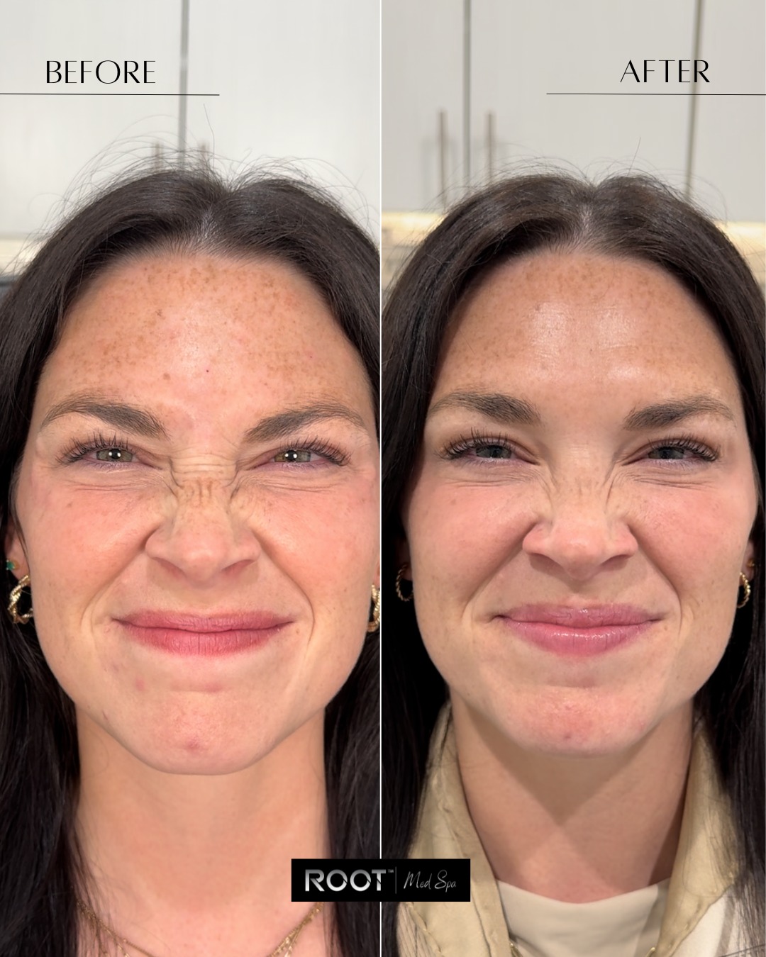 Botox before and after