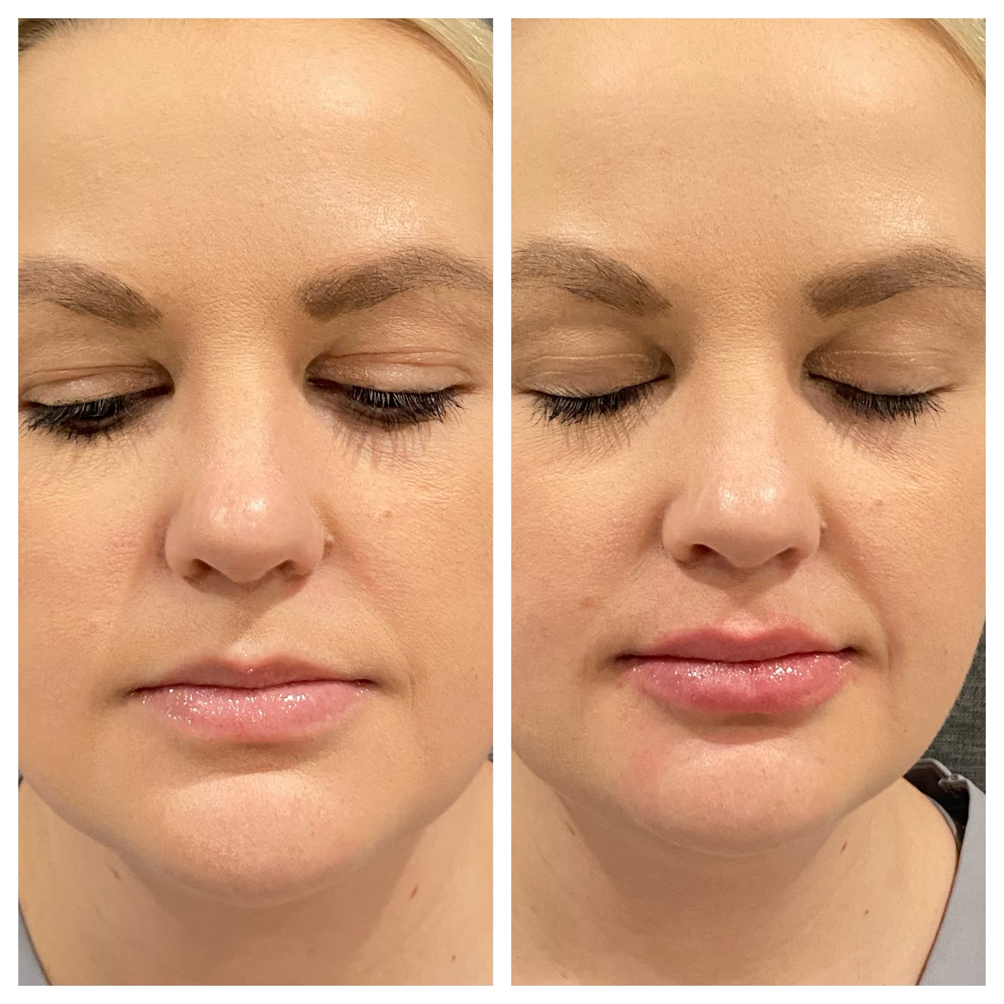 Dermal Filler Lips