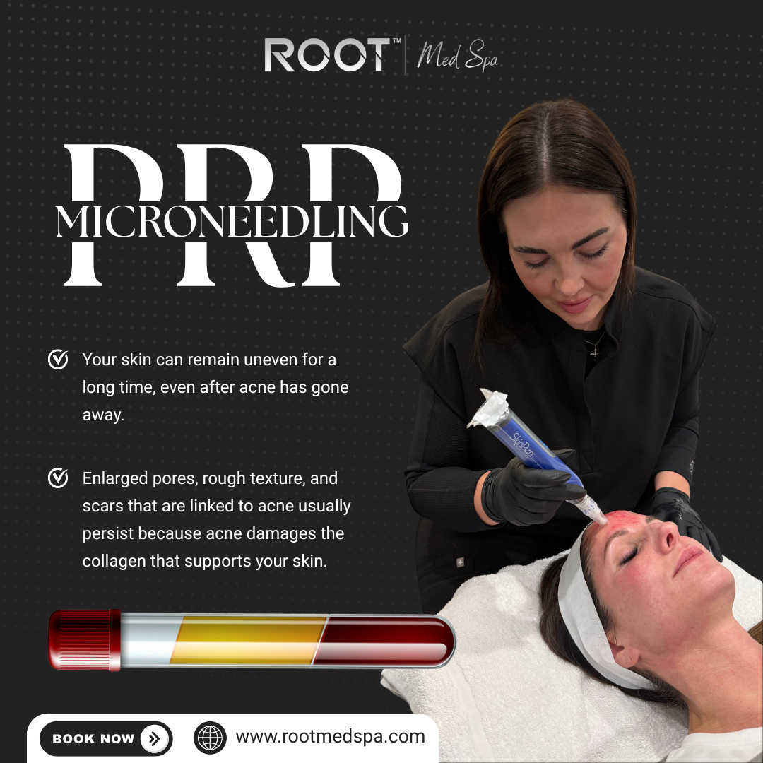 PRP Microneedling in Flower Mound / Coppell, TX