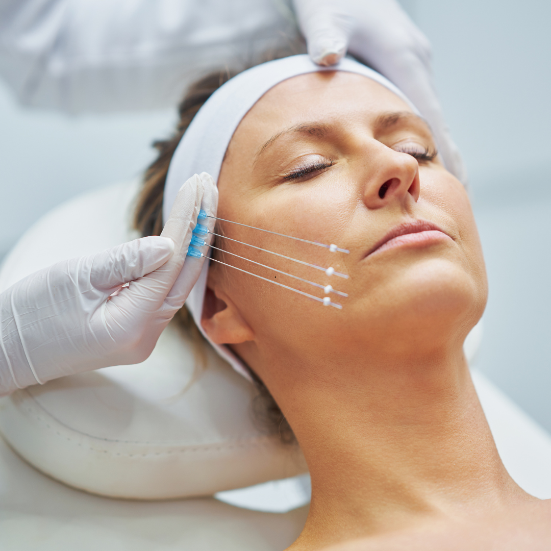 PDO Thread Lift for Neck, Jaw & Wrinkles