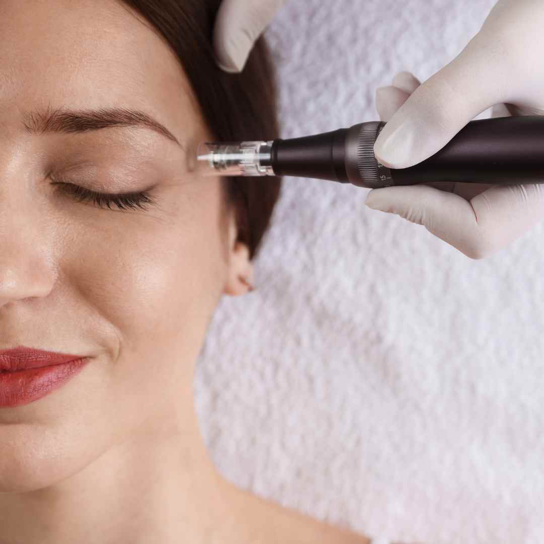 Microneedling for Stretch Marks in Flower Mound/Coppell, TX