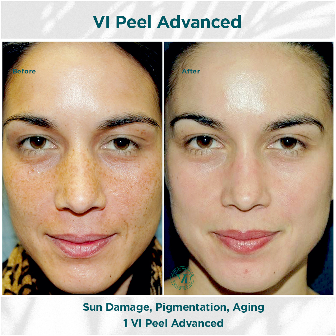 VI Peel Advanced