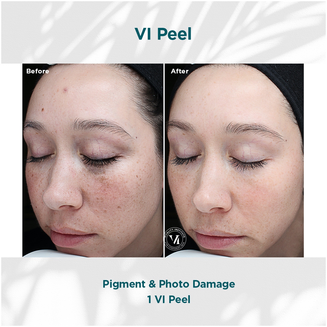 VI Peel Pigment