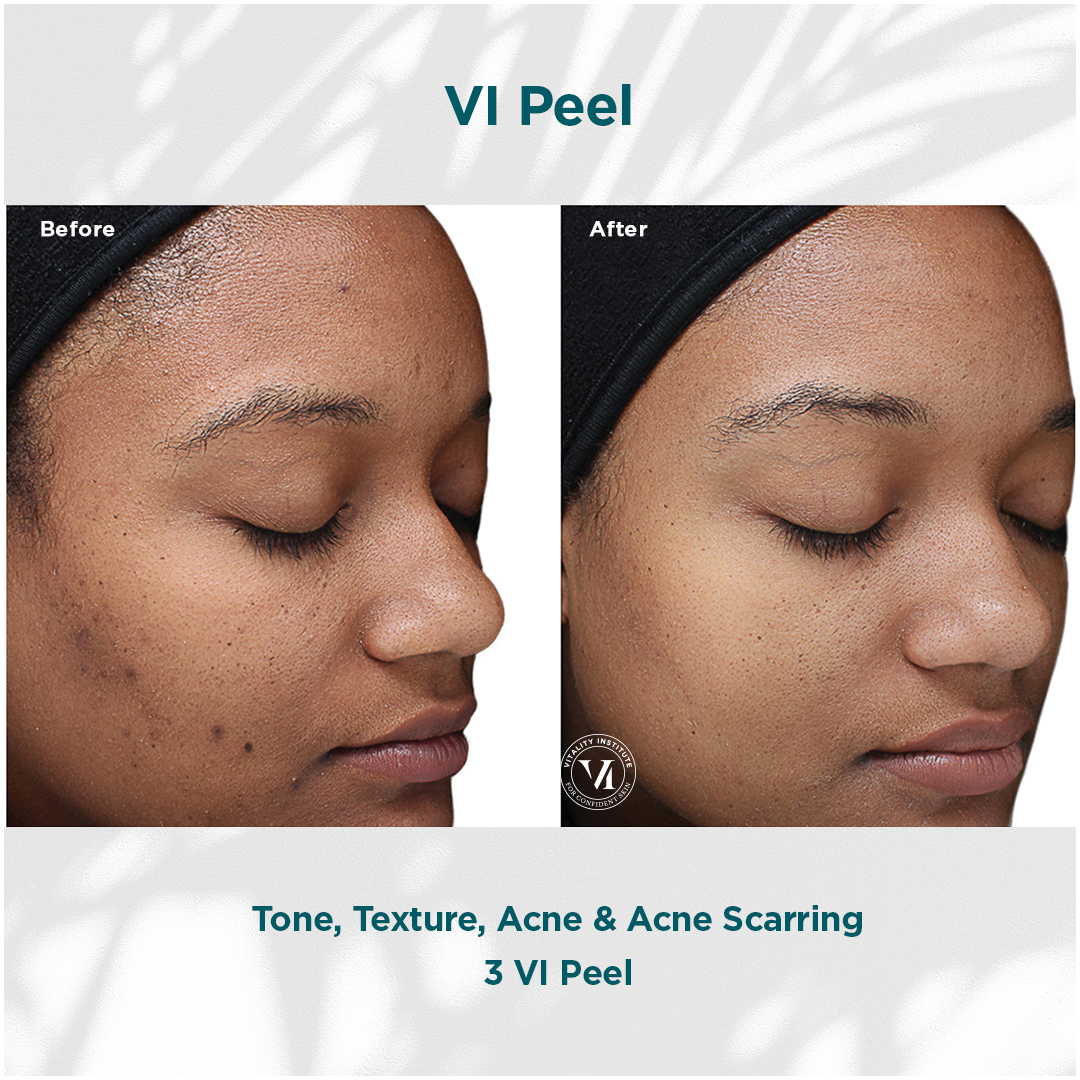 VI Peel Ton tex acne